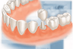 Restorations: Fillings, Onlays, Crowns, Veneers