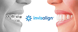 Invisalign