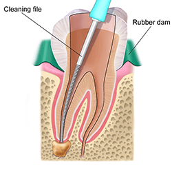 Root Canal Treatment