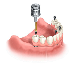 Implants