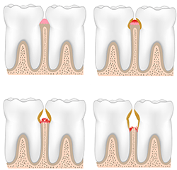 Treatment of Gum Disease